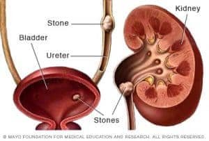 किडनी मूत्राशय की पथरी kidney gurde गुर्दे ki pathri kisme ilaj upay upchar nuskhe