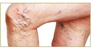 varicose veins treatment in hindi, varicose veins ka ayurvedic aur gharelu ilaj, upay upchar,