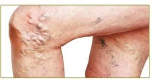 varicose veins treatment in hindi, varicose veins ka ayurvedic aur gharelu ilaj, upay upchar,