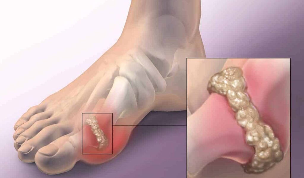 Uric Acid - Causes & control