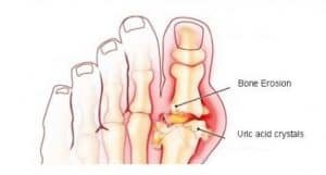 gouty-arthritis Uric Acid - Causes & control