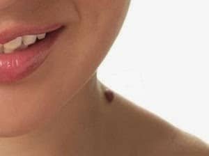 मस्सों के 27 घरेलू उपचार Warts masse masson ka gharelu ilaj upay upchar